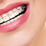 How dental crowns are installed?