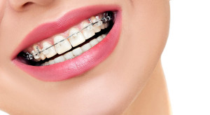 How dental crowns are installed?